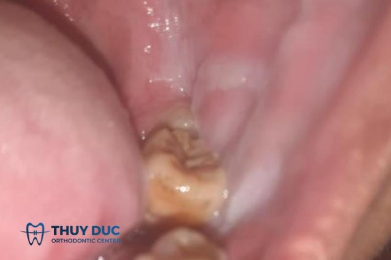 Hình ảnh minh họa các dạng cặn sữa khác nhau: mảng trắng sần sùi, lớp màng mỏng, và cặn bám màu vàng nhạt.