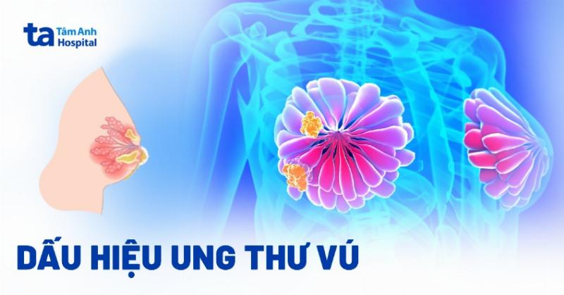 Hình ảnh minh họa các dấu hiệu cảnh báo cần đi khám bác sĩ khi phát hiện cục cứng ở ngực.