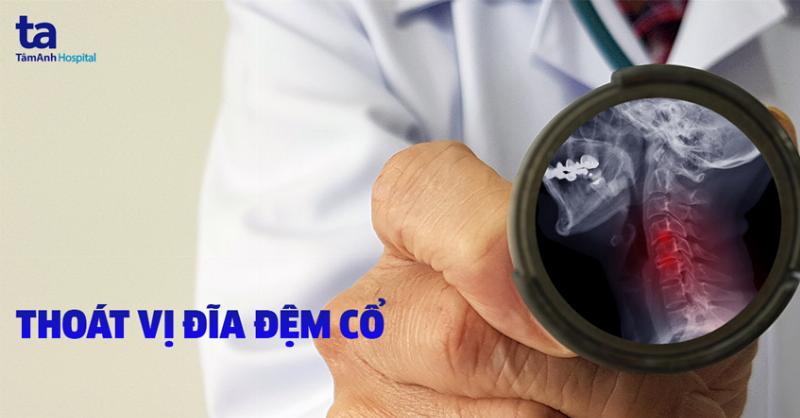 Hình ảnh minh họa phương pháp vòng đệm để tính thể tích khối tròn xoay có lỗ rỗng, cho thấy các lát cắt hình vòng đệm.