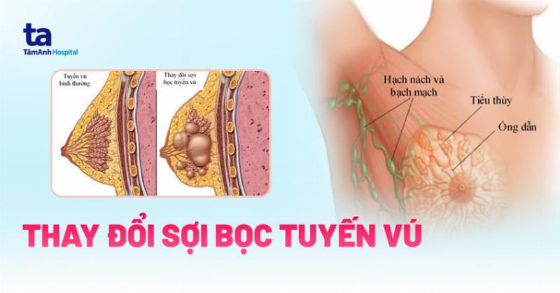 Hình ảnh minh họa các nguyên nhân lành tính phổ biến gây ra cục cứng ở ngực như u xơ, nang vú, thay đổi sợi bọc.